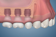 Bicon Implant Posterior Maxilla with Atrophy